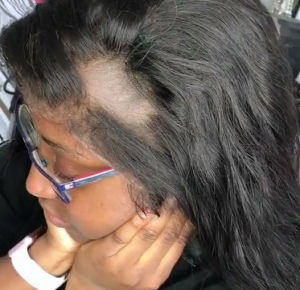 what should I do to repair bald frontals or closures Bring frontals or closures back to life April Lace Wigs Hair Tips Blog